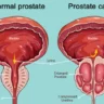 प्रोस्टेट कैंसर